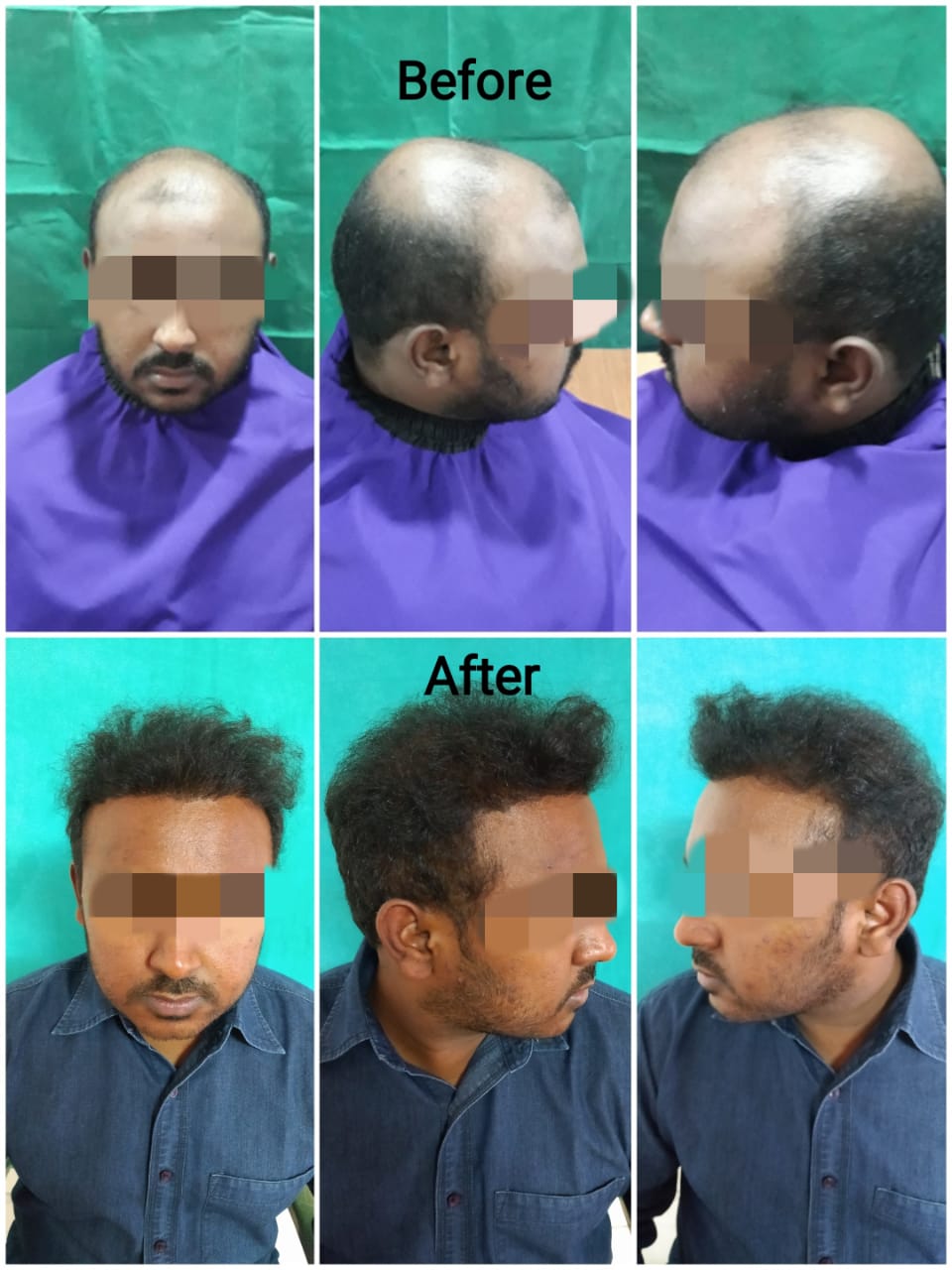Hair Transplant In Visakhapatnam  PRP Treatment Vizag