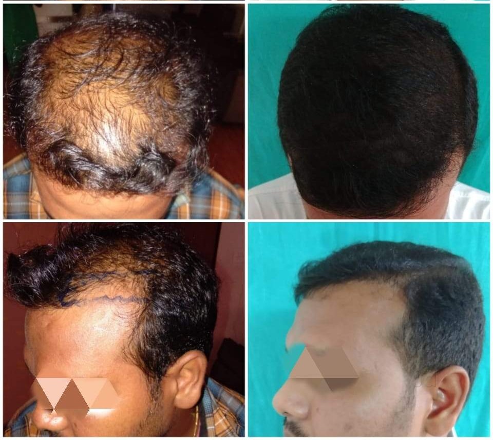 Dr Raju - Best Hair Transplantation And Restoration Centre in Vizag